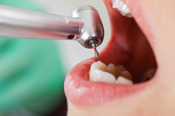 Best Chipped Tooth Repair Near Me  in South Russell, OH